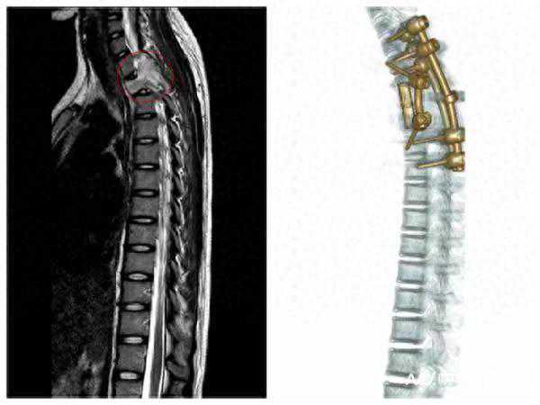 15岁女孩颈部酸痛竟致瘫痪，原来是胸椎长肿瘤