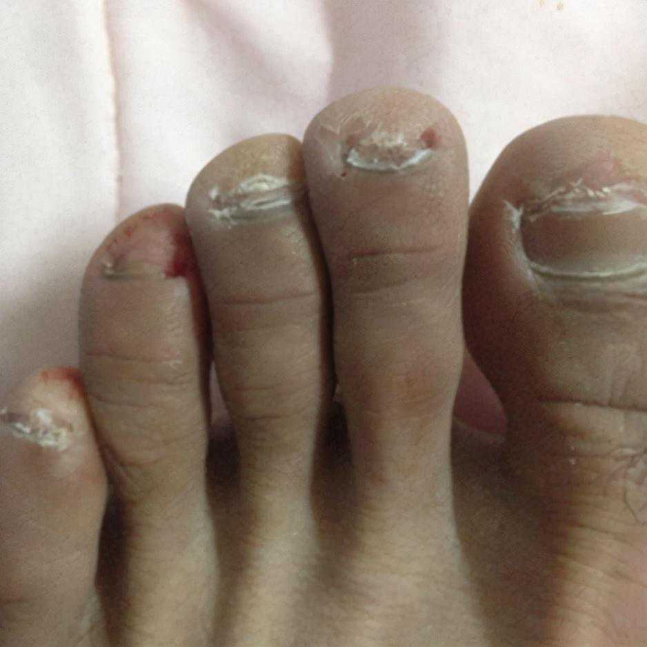 治疗灰指甲医院竟然做化验？