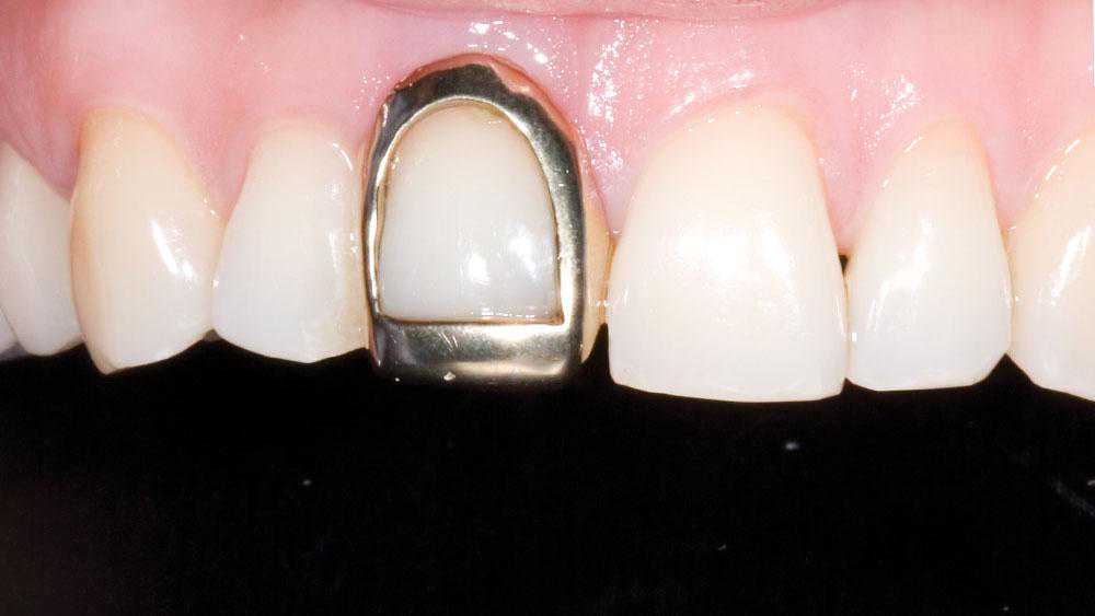 牙科医生讲义第十六讲：解读什么是部分冠